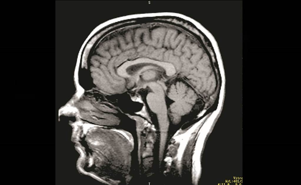 Extirpan tumor cerebral a paciente despierto