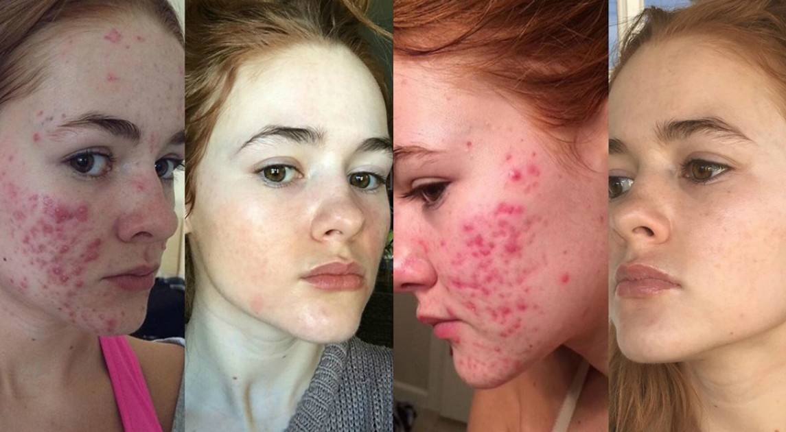Esta cuenta de Instagram cambiará la forma de ver a las personas que sufren acné