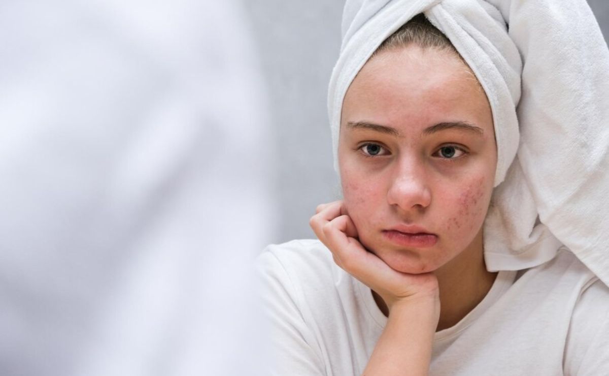 Cómo se relaciona el acné en adultos con la depresión, según estudios