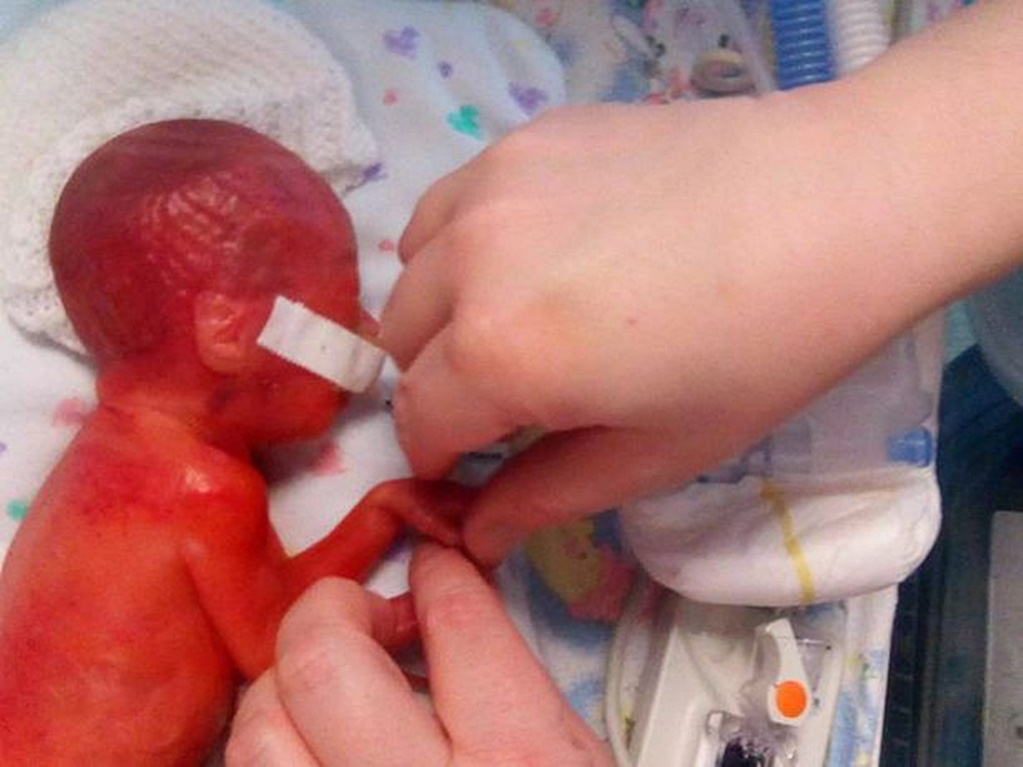 Mujer muestra cómo su bebé prematura nació con la piel roja y casi transparente