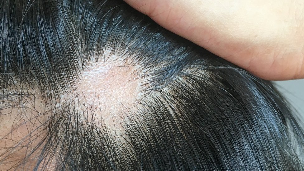 Coronavirus: ¿Qué causa y cómo tratar la caída del cabello por Covid-19?