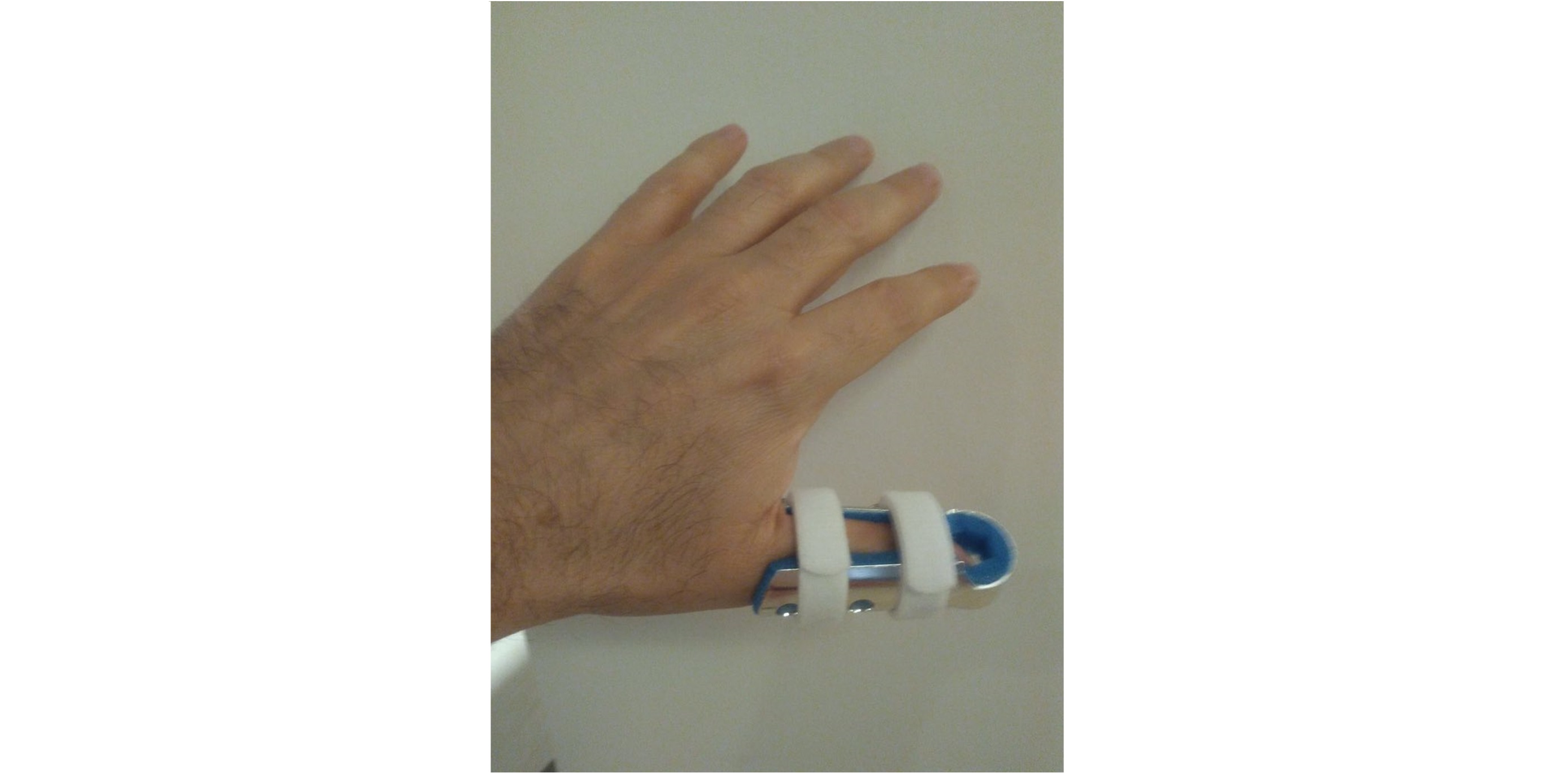 Eruviel Ávila sufre fractura en la mano