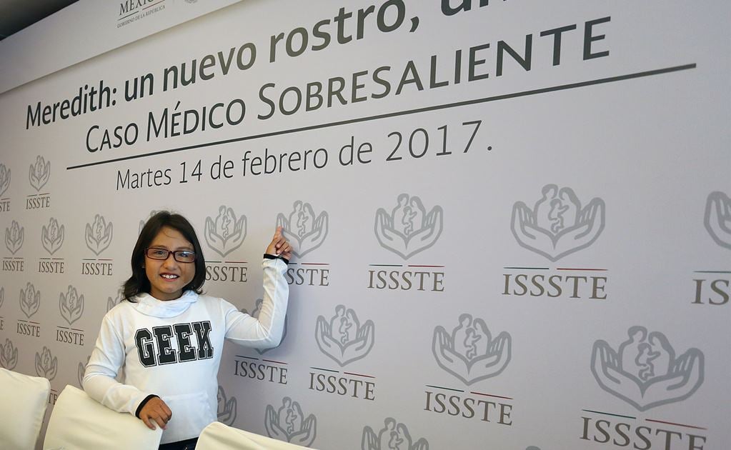 ISSSTE reconstruye rostro a niña de 7 años