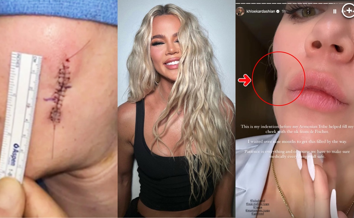 El cáncer de piel dejó una hendidura en la mejilla de Khloé Kardashian