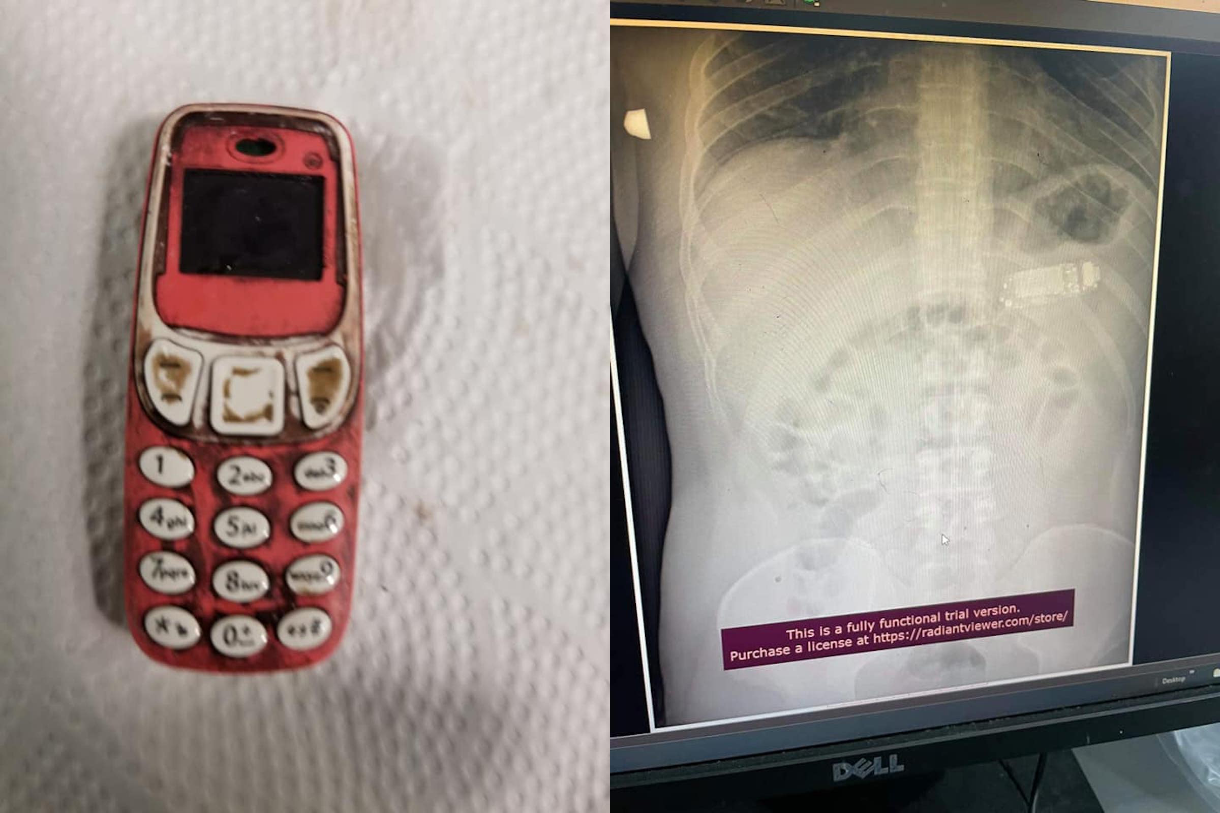 Viral: Hombre se traga un Nokia 3310 y termina en el hospital