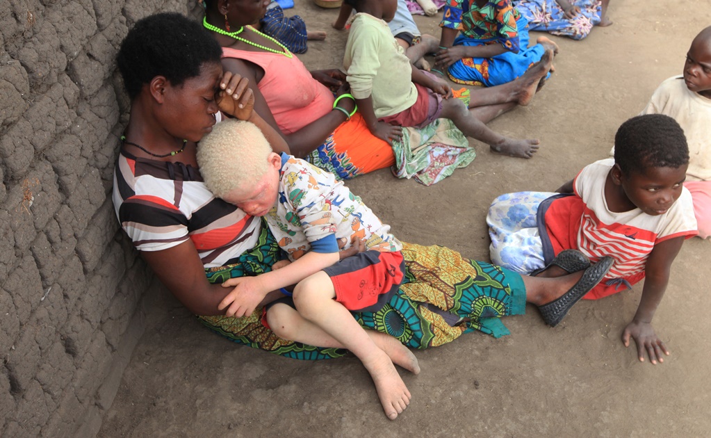 Se recrudece asesinato de albinos en Malaui 
