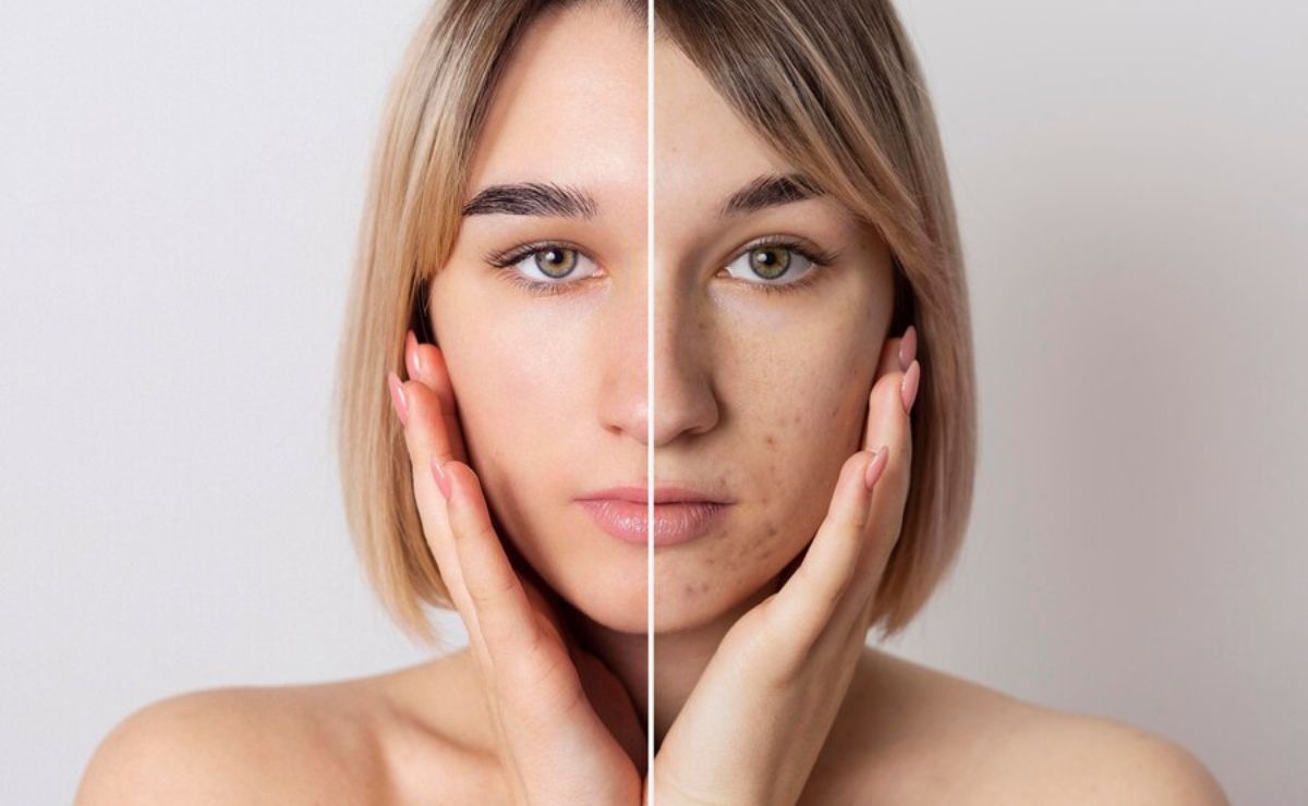 Descubre cómo eliminar el acné de tu piel