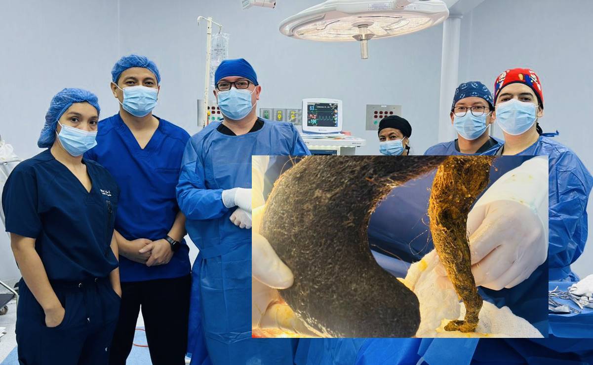 Extraen bola gigante de cabello del estómago de una joven de 24 años en Ecuador