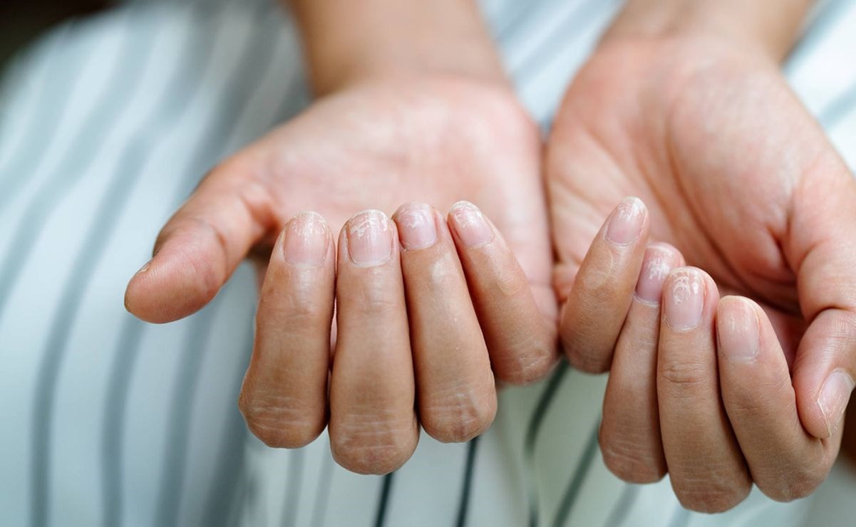 Por qué aparecen estrías en las uñas de las manos