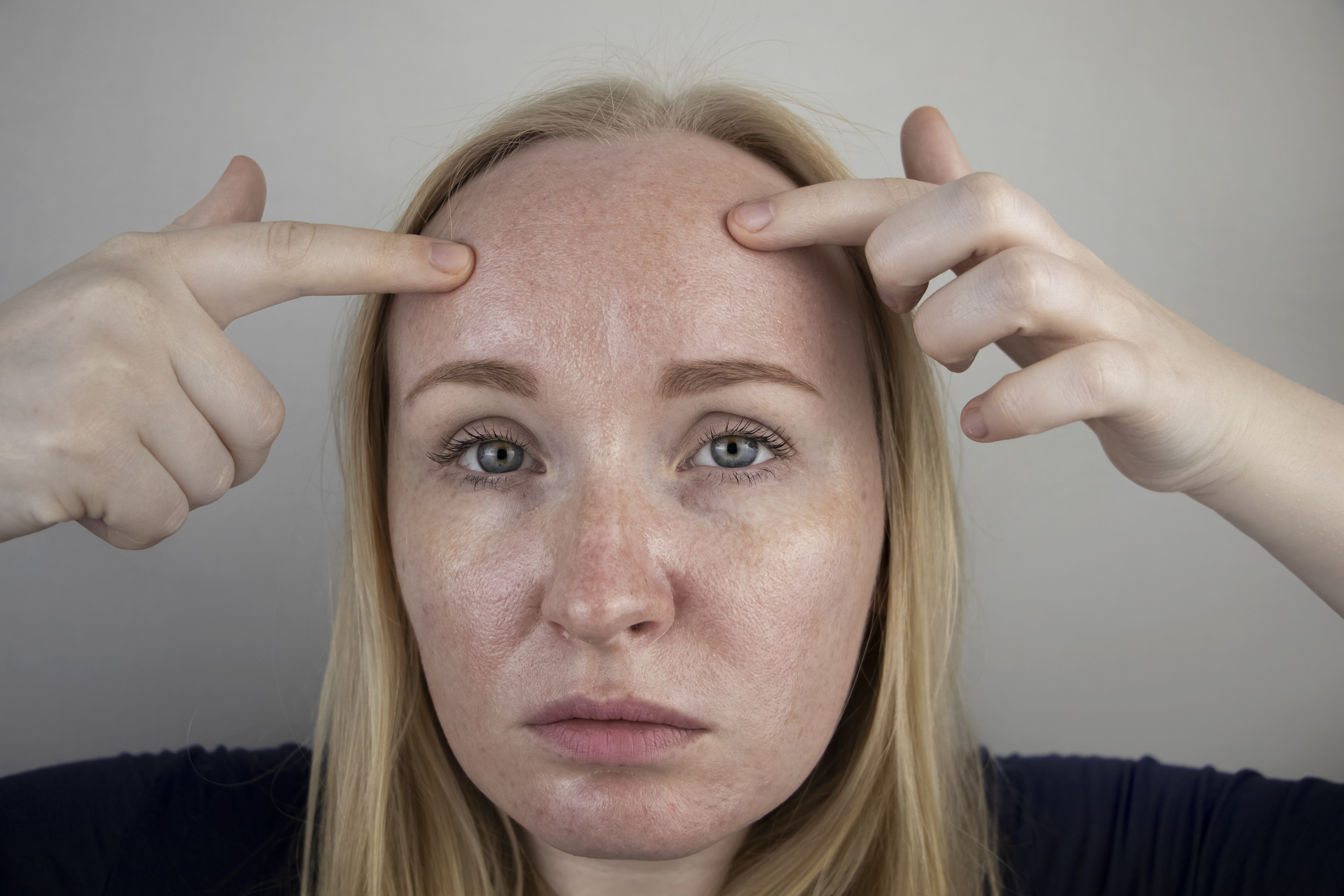 ¿Por qué salen manchas blancas en la piel? ¿Cómo se quitan? Esto dice Cleveland Clinic