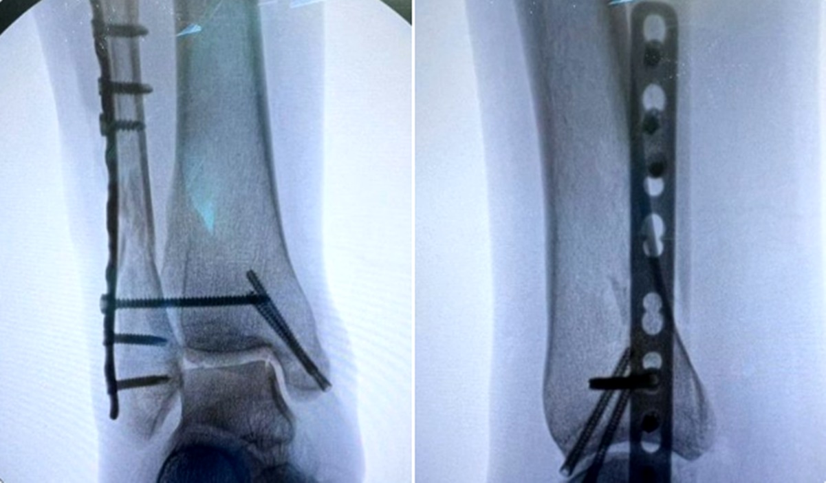 "El pie se había separado del tobillo por la caída"; cooordinadora de Álvarez Máynez sube radiografías tras cirugía