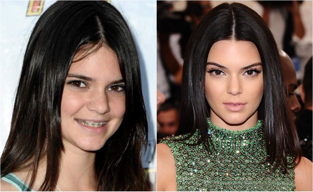 El antes y el después de las cirugías de Kendall Jenner