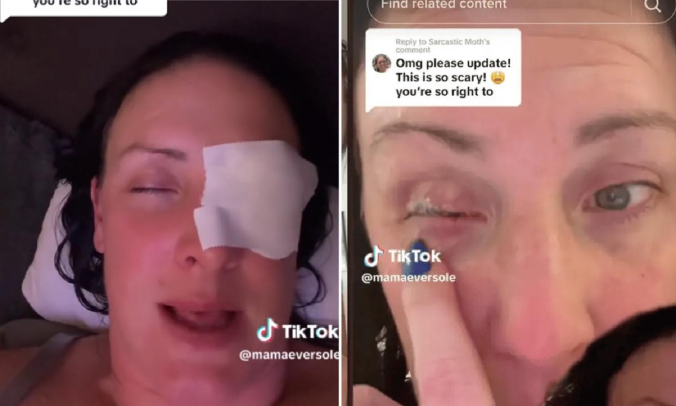 Mujer confunde gotas de ojos con pegamento y termina en el hospital
