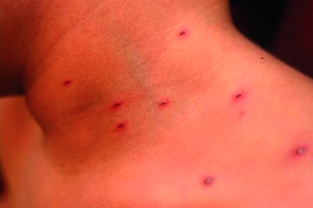 Activan alerta epidemiológica por brote de varicela en Yucatán