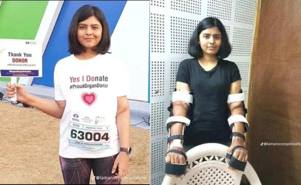 Shreya Siddanagowda, la joven que recibió trasplante de brazos de un hombre y logró adaptarlos a su cuerpo