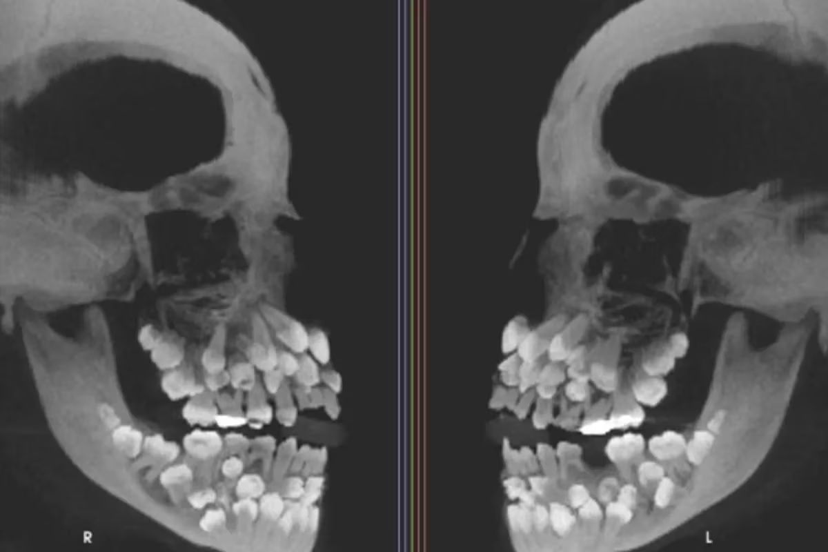 El extraño caso de una niña con 81 dientes que desafió a odontólogos