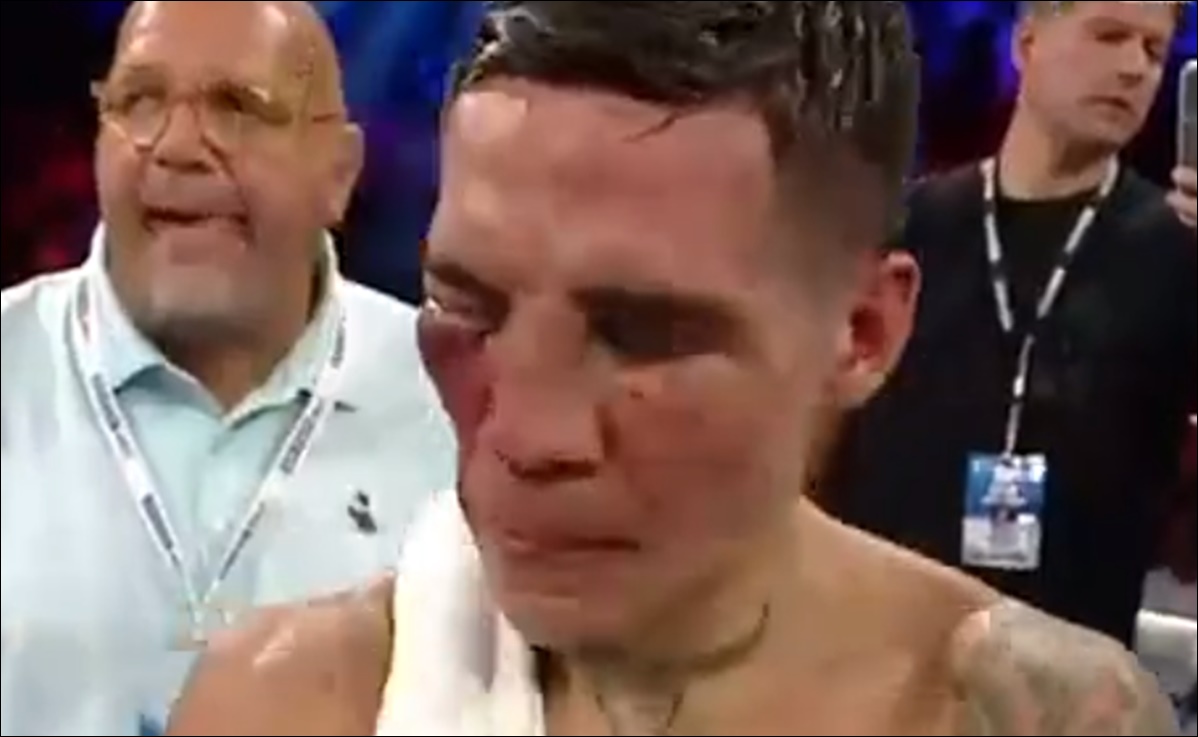 La impactante imagen que revela las heridas en el rostro de Oscar Valdez tras la pelea con el 'Vaquero' Navarrete