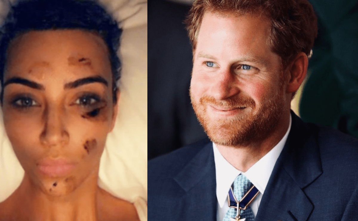 Kim Kardashian, el príncipe Harry y otros famosos con acné, psoriasis, rosácea y otras enfermedades de la piel