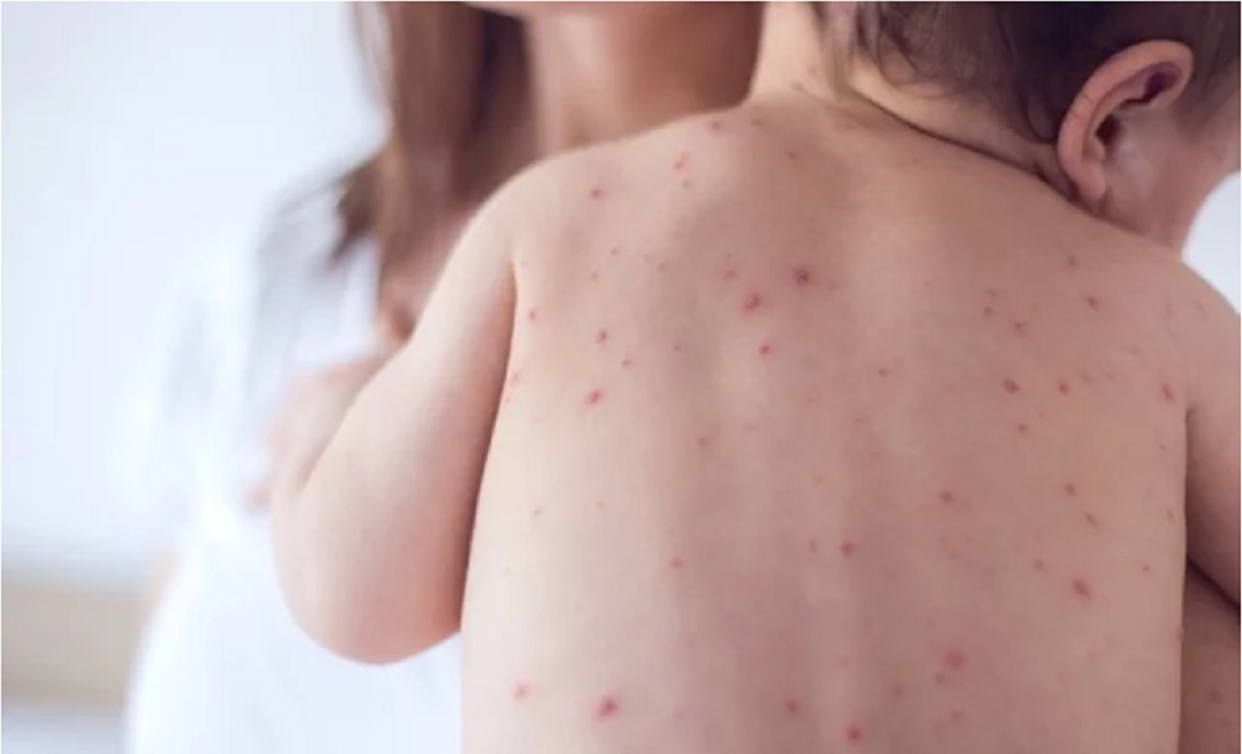 Un niño francés sin vacunar reintrodujo el sarampión a Costa Rica