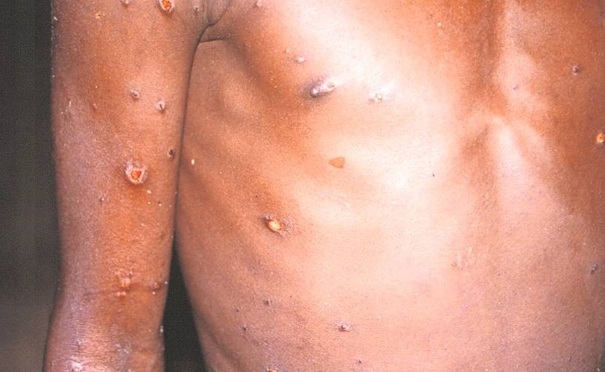 Viruela símica: Esto recomienda la Secretaría de Salud para evitar contagios