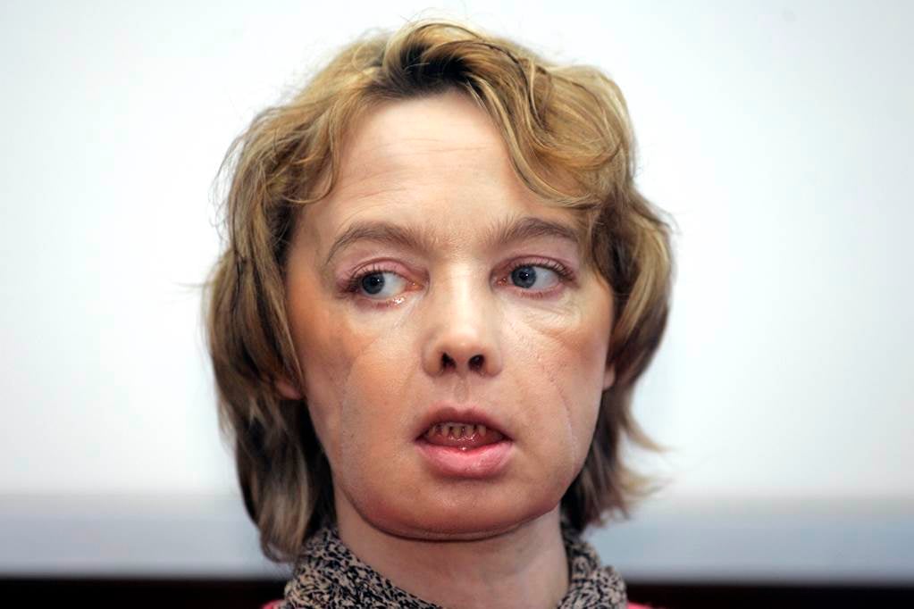 Muere la mujer francesa que recibió el primer trasplante mundial de cara #DUPLICADA