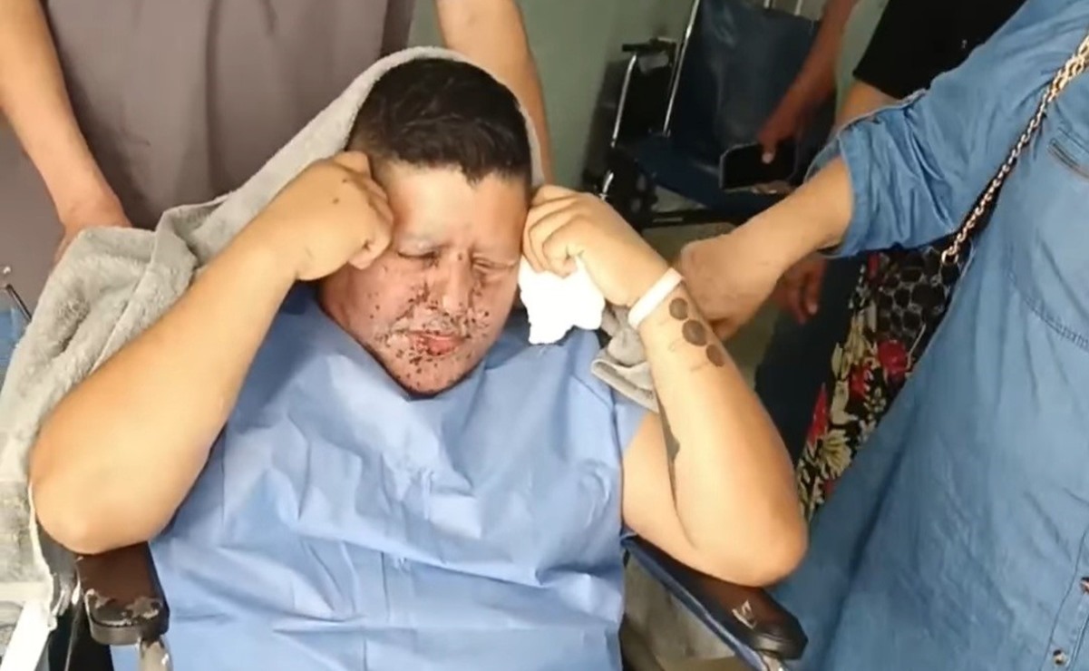 Payasito enciende cuete y le explota en la cara al celebrar el Año Nuevo en Tamaulipas