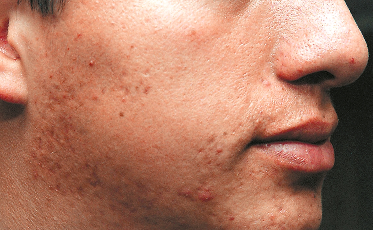 De vuelta a la adolescencia: el acné se reactiva por uso de cubrebocas