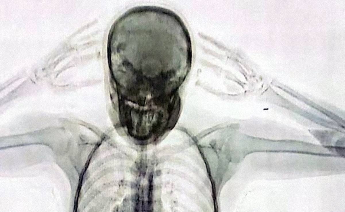 Impactante: Así se ve en rayos X el cuerpo de una mujer que traficaba 78 cápsulas de cocaína