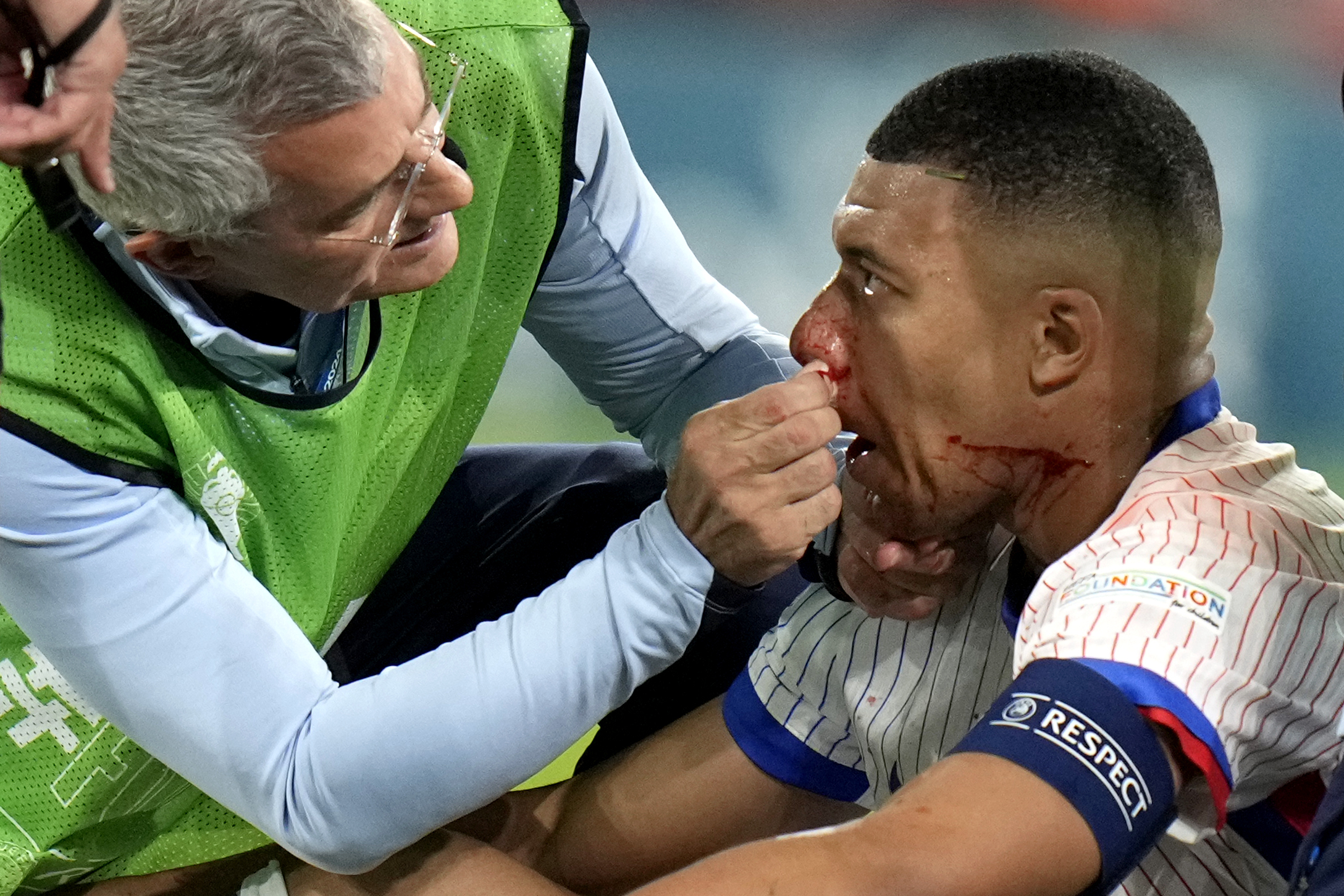 Mbappé fracturado: El impactante choque que lo deja fuera del partido Austria-Francia en la Eurocopa