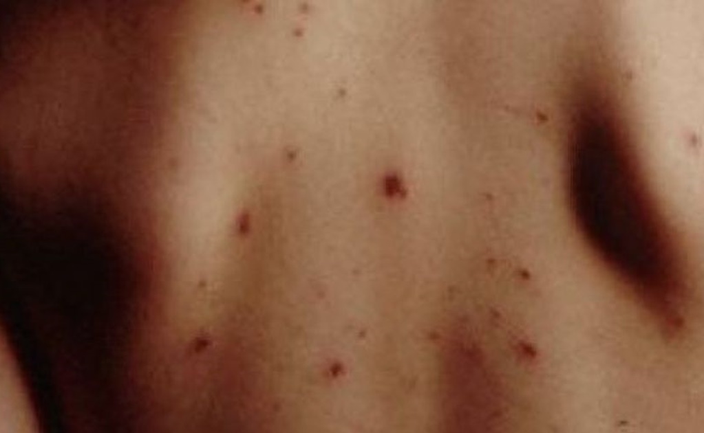Reportan más de 2 mil casos de varicela en Yucatán 