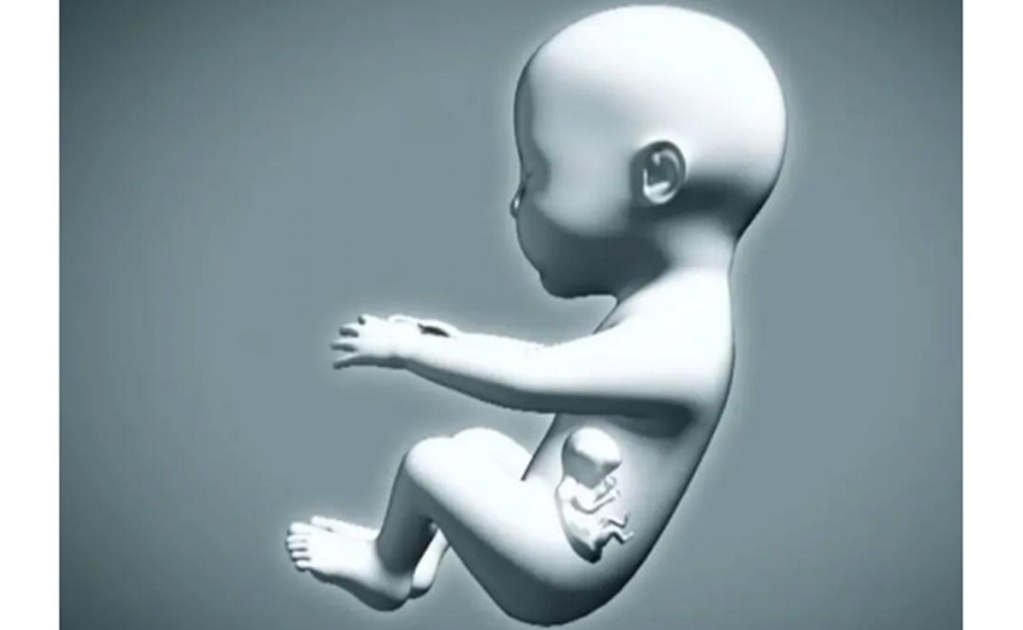 Nace bebé "embarazada" de su hermano gemelo en Colombia