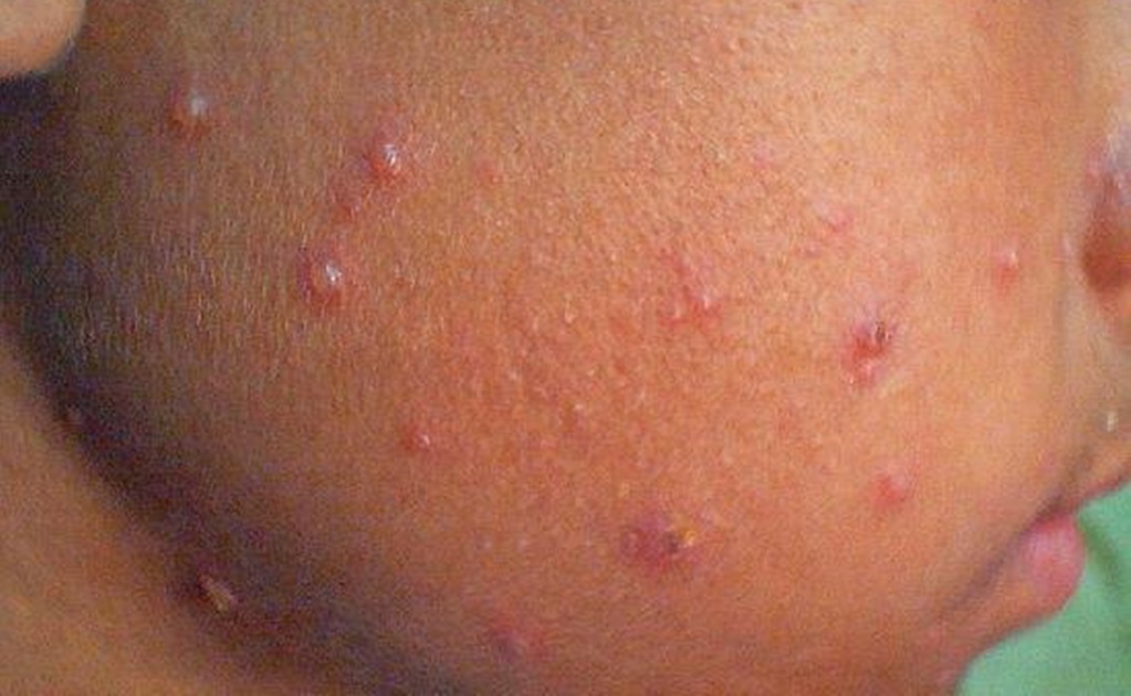 Reportan dos mil 500 casos de varicela en Yucatán 