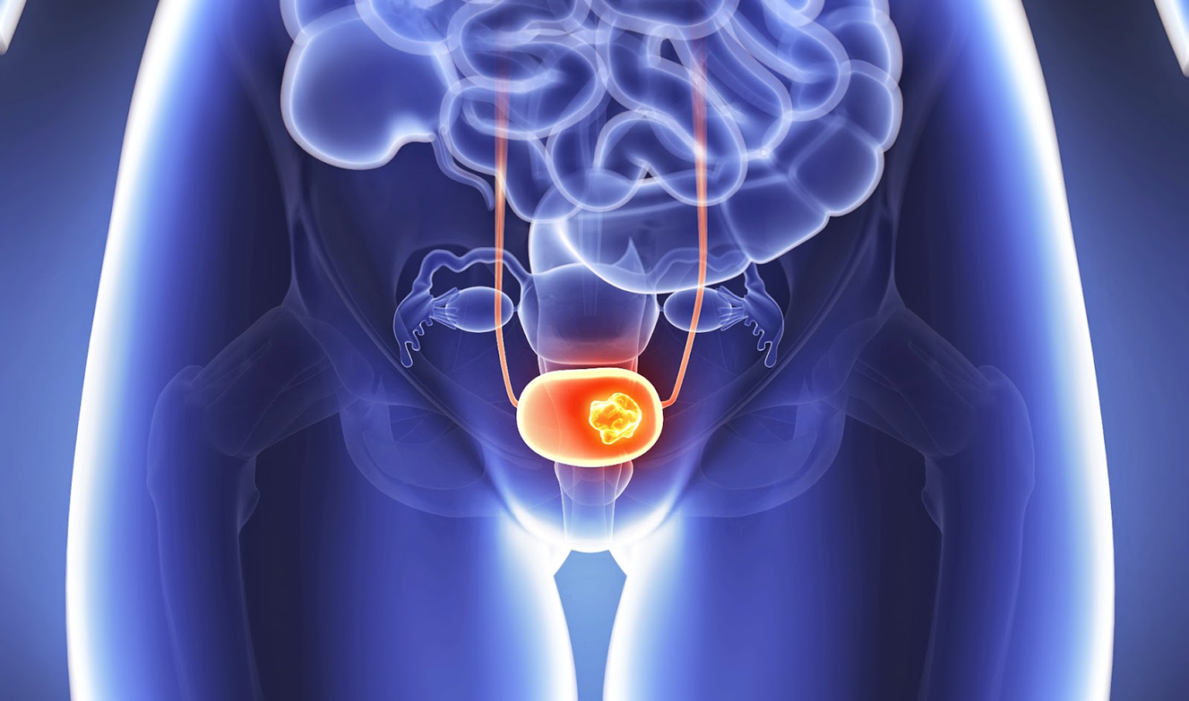 Estos son los primeros signos y síntomas del cáncer de vejiga ¿Cómo identificarlos? Salud La Revista El Universo imagen foto imagen