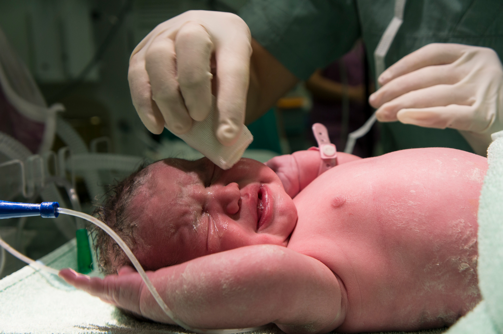 Entenda sobre a icterícia neonatal e seu tratamento adequado