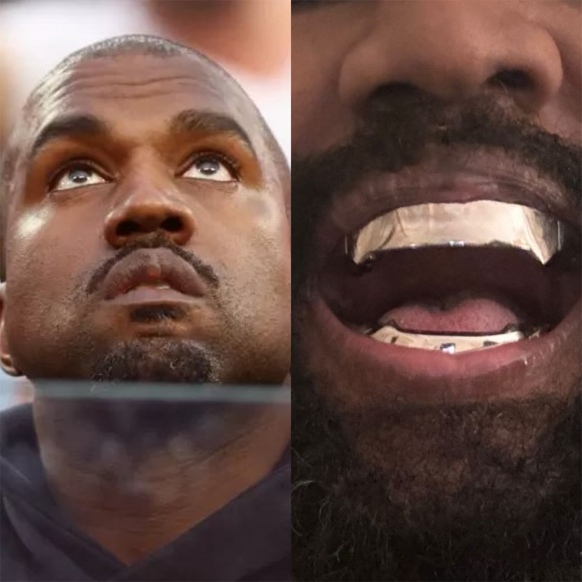 Nice Teeth Rappers Dentes De Rapper Antes E Depois Cantor Implanta Dentes De Vampiro E