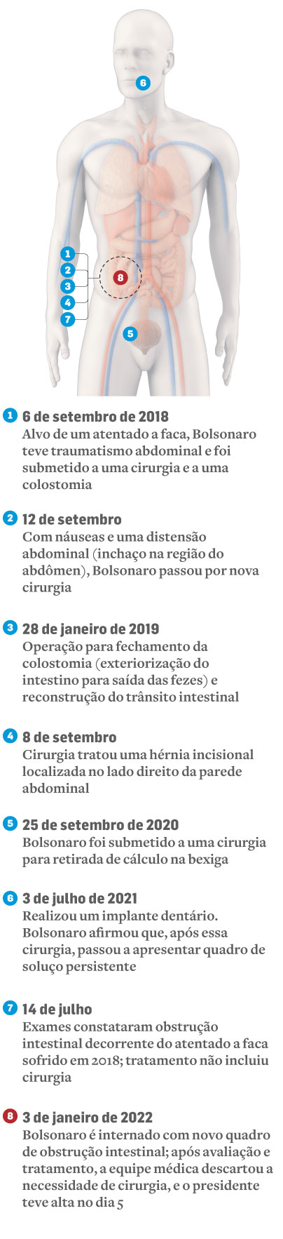 Entenda a cirurgia de hérnia incisional que Bolsonaro fará