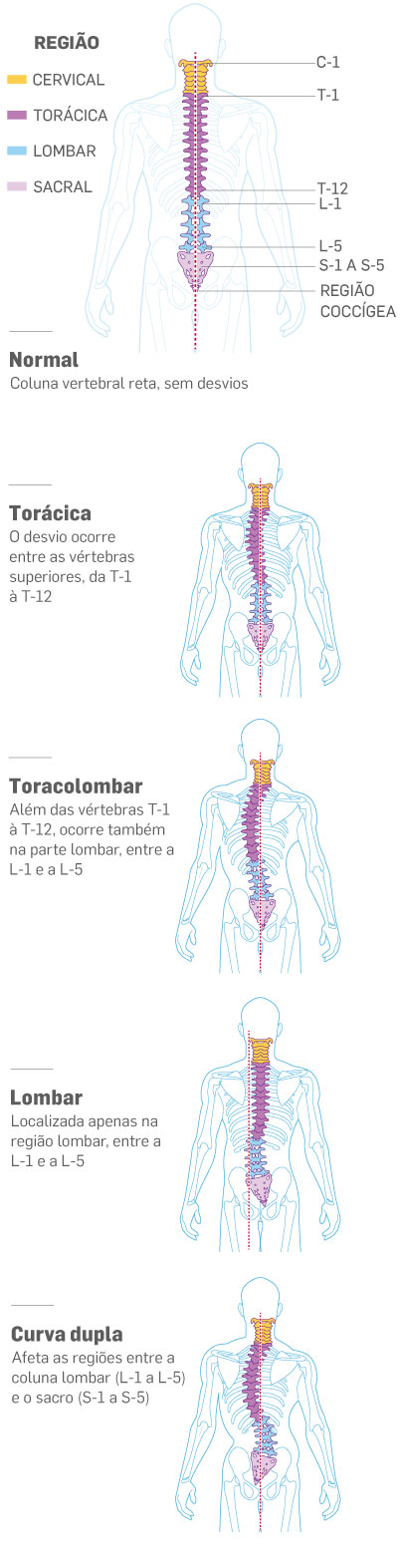 musculação #escoliose #escoliosis #coluna #colunavertebral