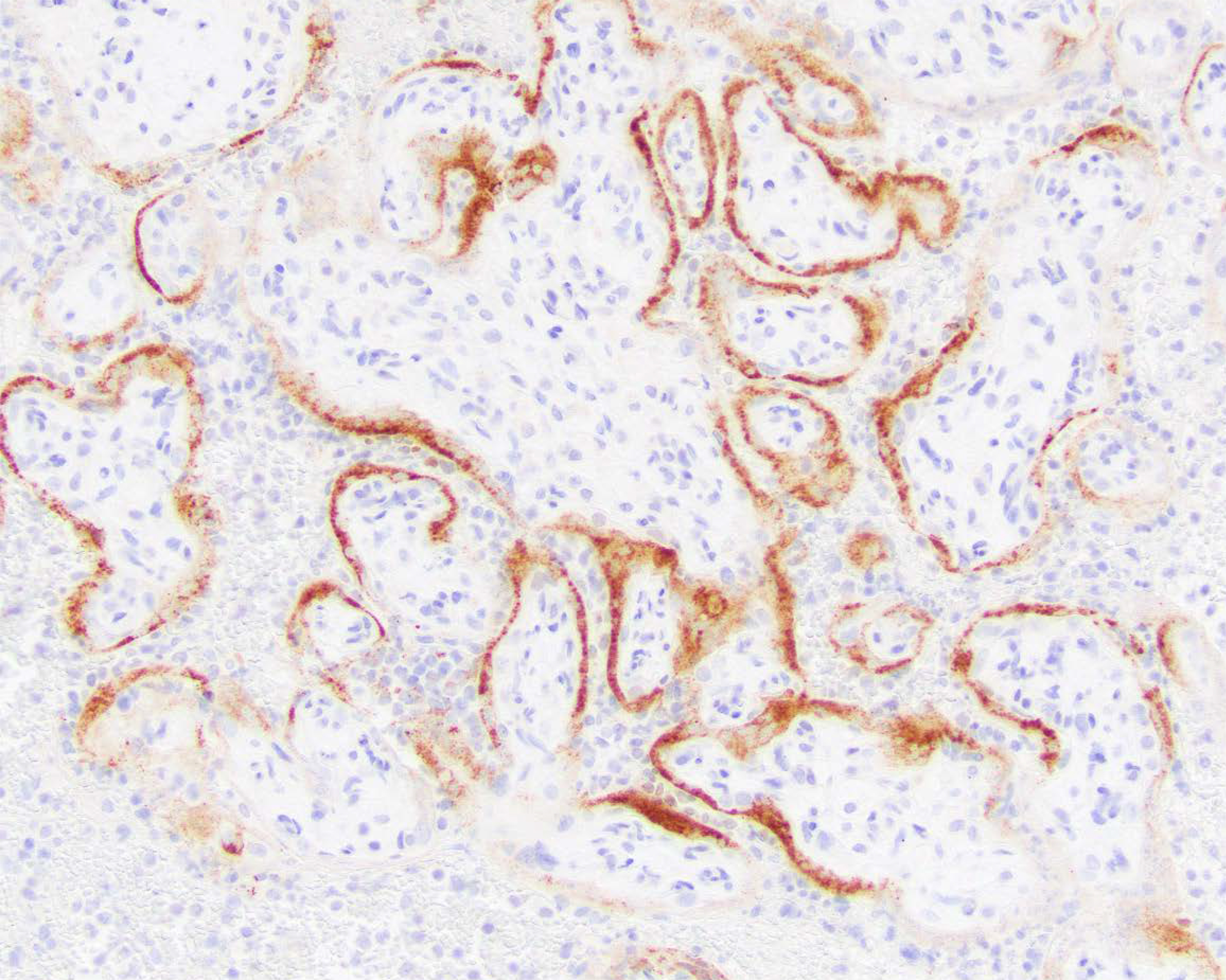 Coronavirus can destroy the placenta and lead to stillbirths