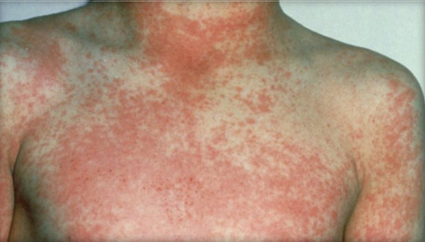 How to spot tell-tale scarlet fever rash as cases soar and 6 kids die in  Strep A outbreak