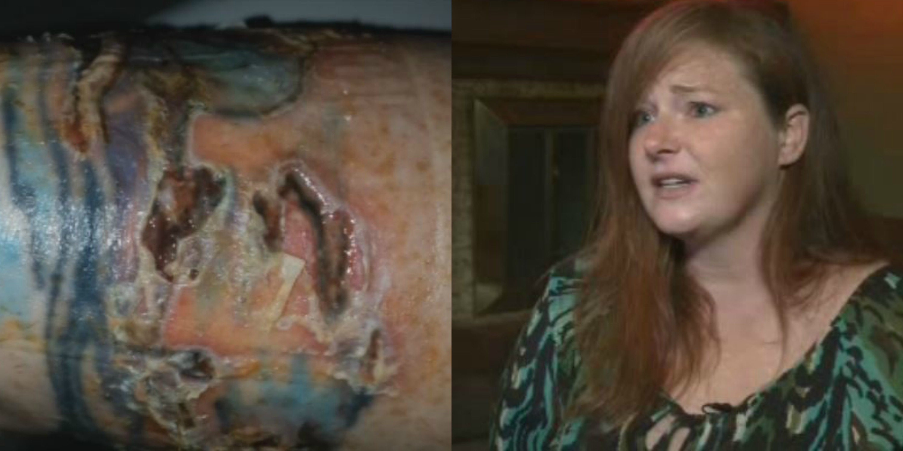 Local woman suffers 3rd-degree burns from laser hair removal