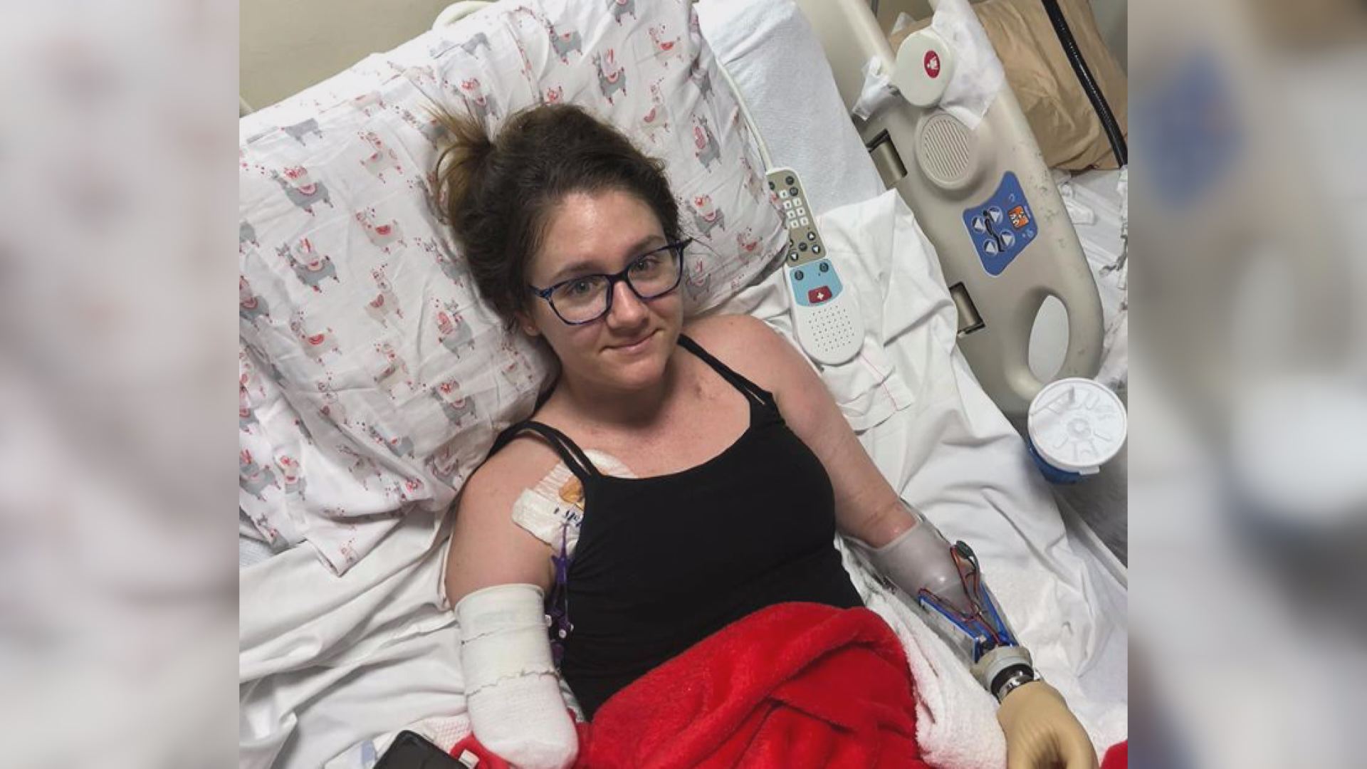 Woman has limbs amputated after developing toxic shock syndrome