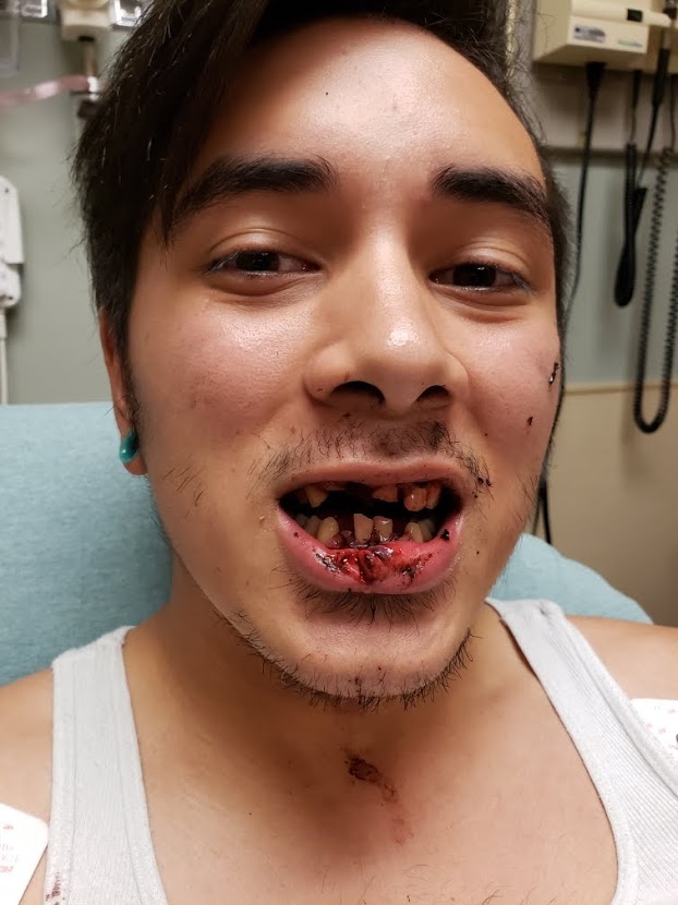 vape exploding GRAPHIC: Mom warns against vape pen after one explodes, leaving son with  shattered jaw