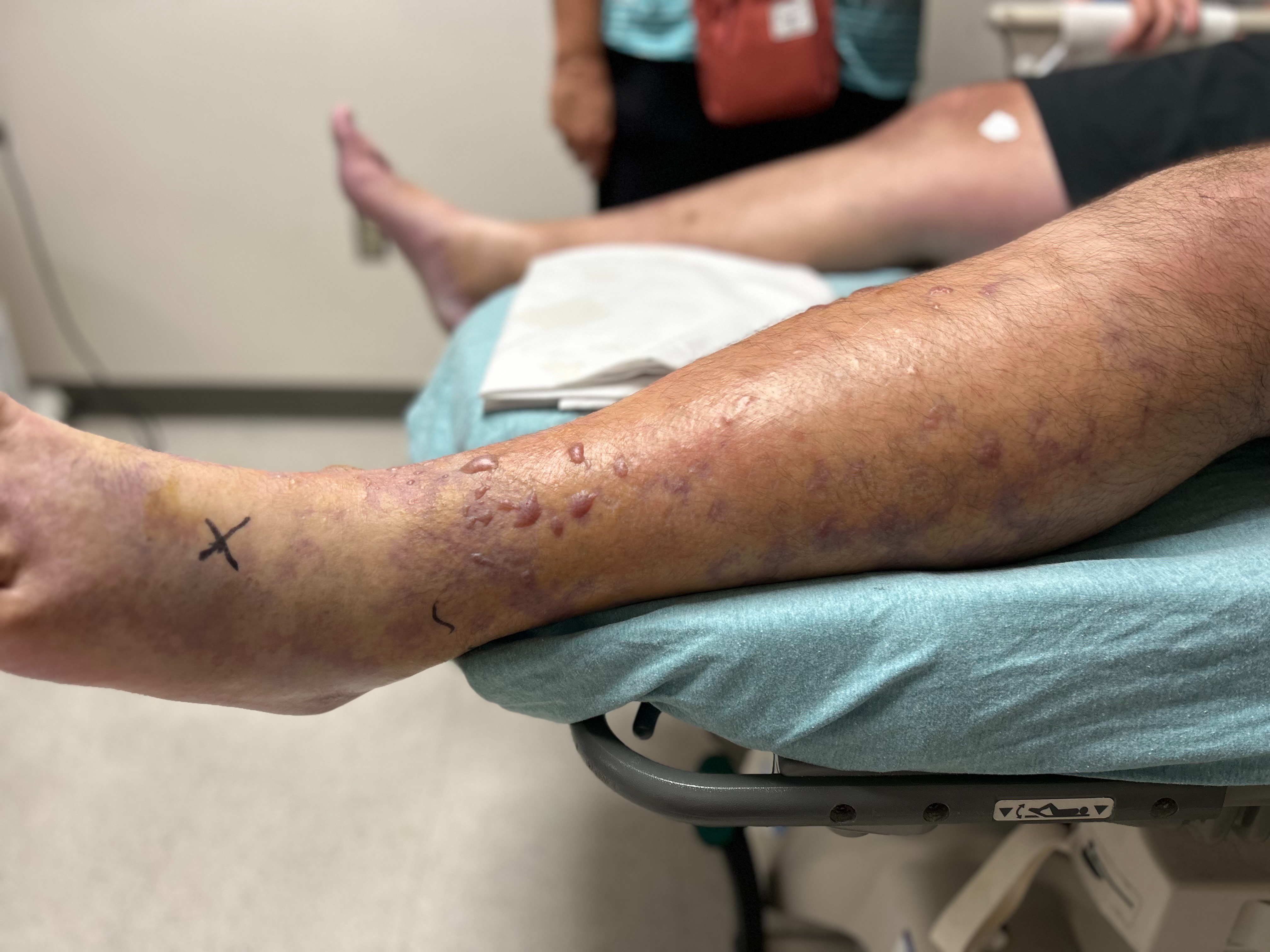b12 injection flesh eating bacteria God on our side': Father fighting for his life after getting infected with flesh-eating Stay Healthy with B12 SUPPLIES/Supplements Size:.5 Gram