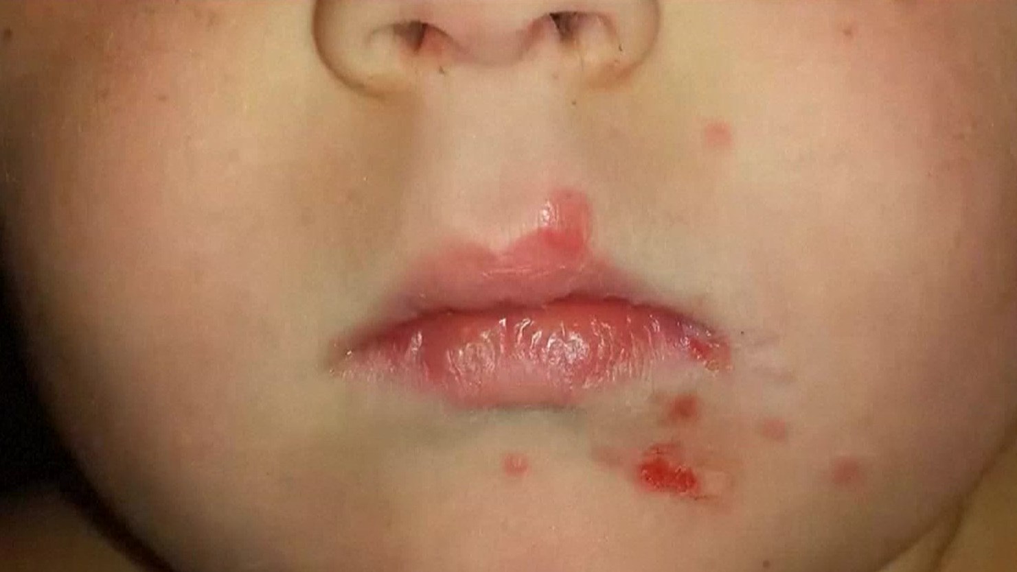 hand foot and mouth disease adults face