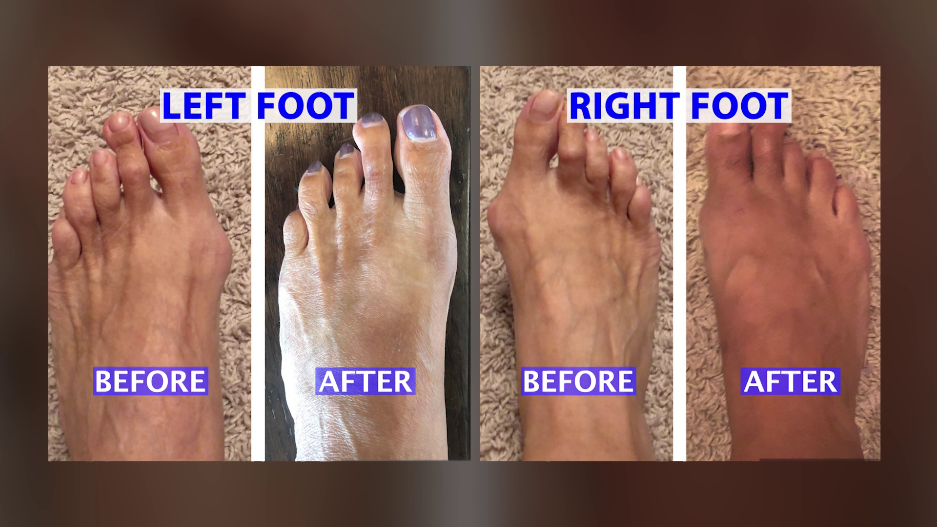 Bunion Surgery Before and After Photos