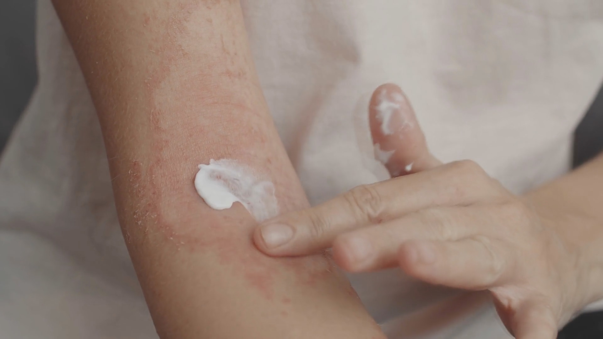 Health care providers offer tips on treating eczema