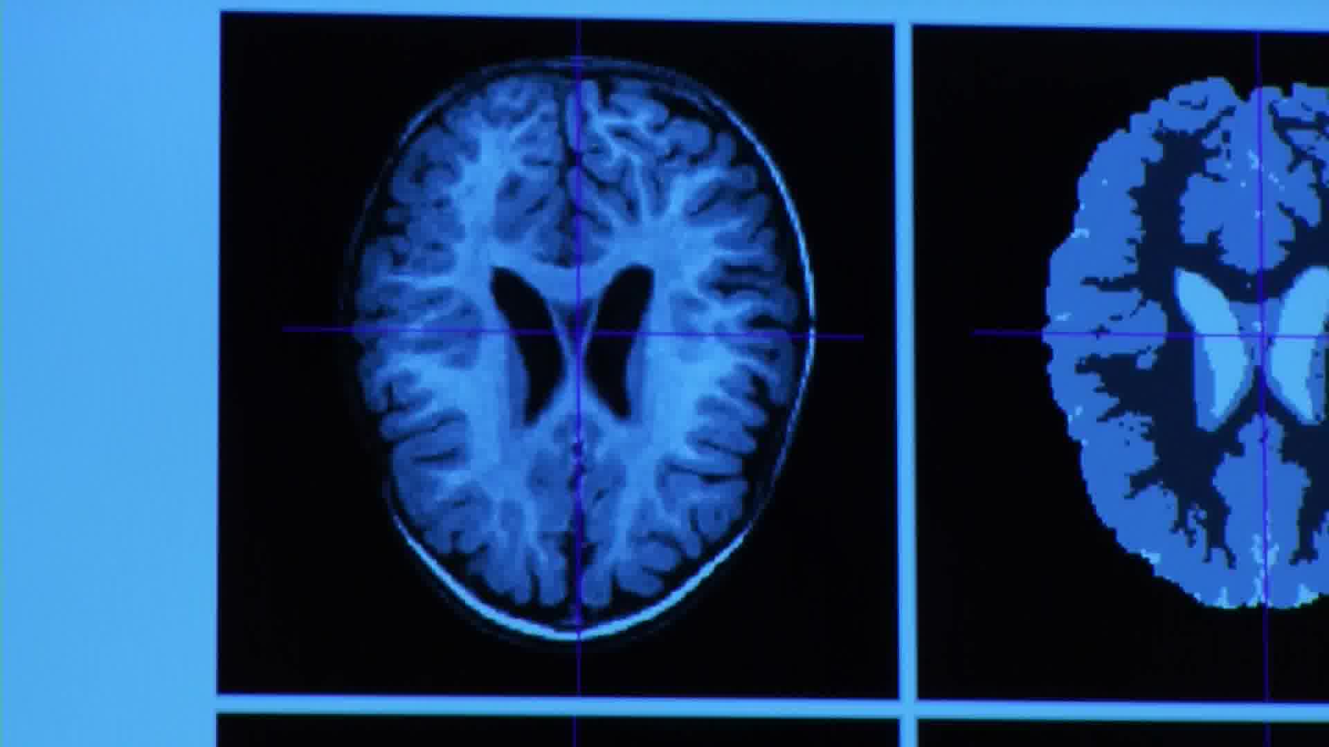 Researchers study babies' brains to diagnose early signs of autism