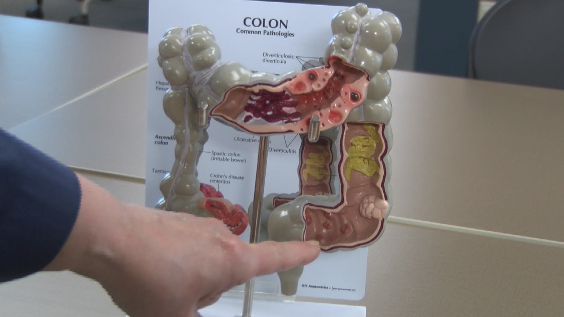 colon様 Early detection is best to prevent colon cancer from spreading