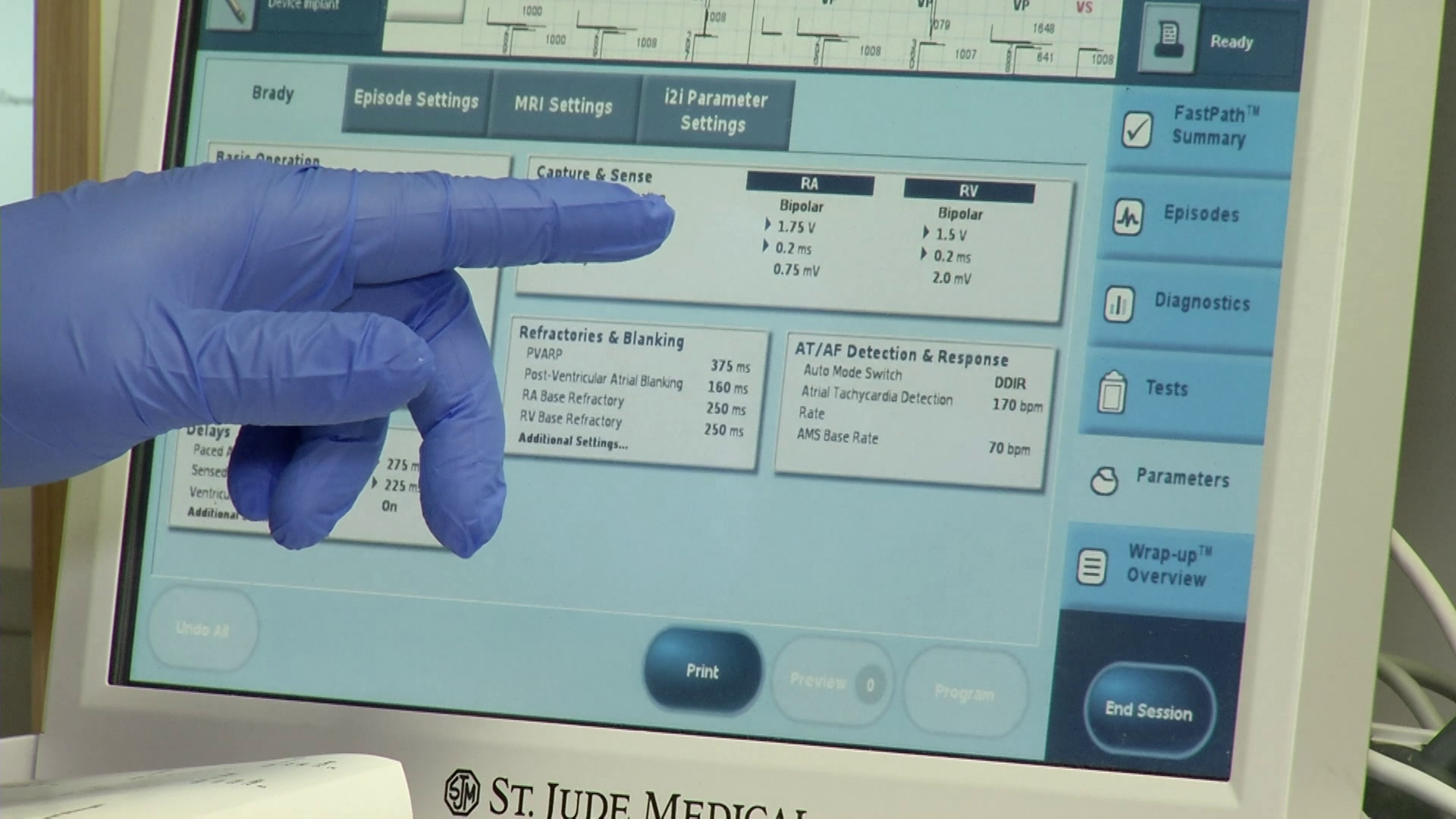 Medical Moment: Wire-free pacemakers