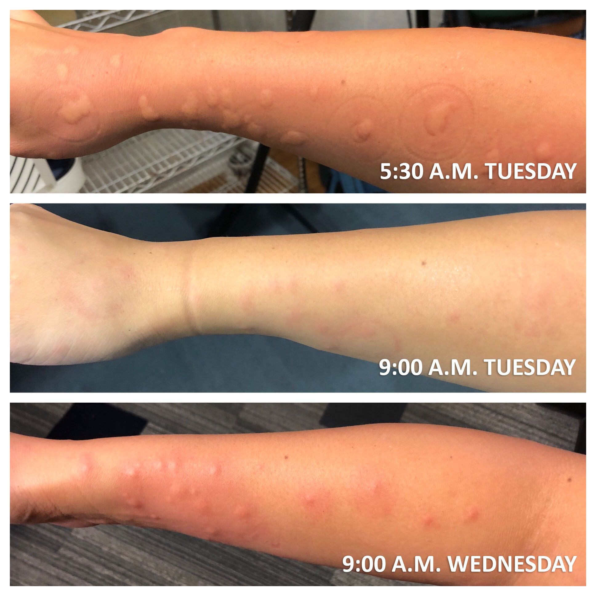 The Bug Bite Thing Works Fast, According to Pediatrician